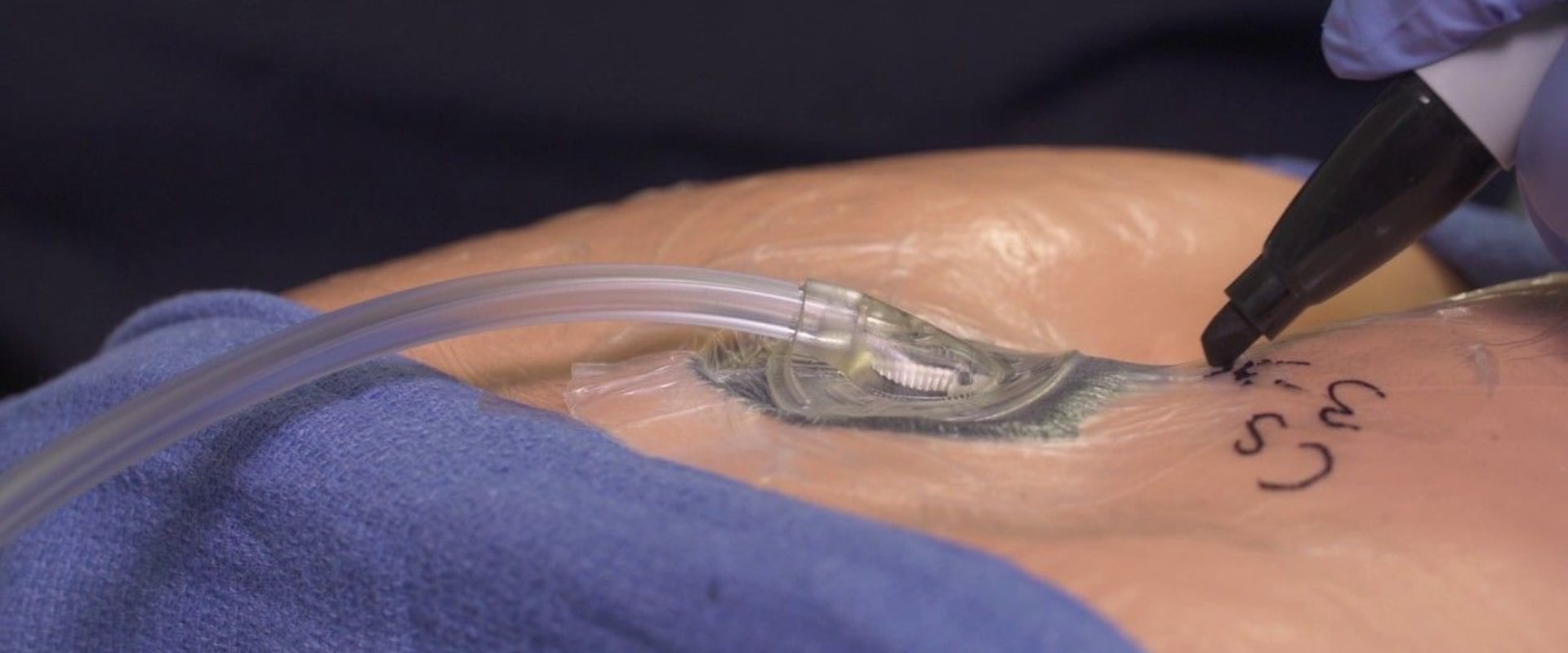 Managing Wound Vacuums: An Expert's Guide