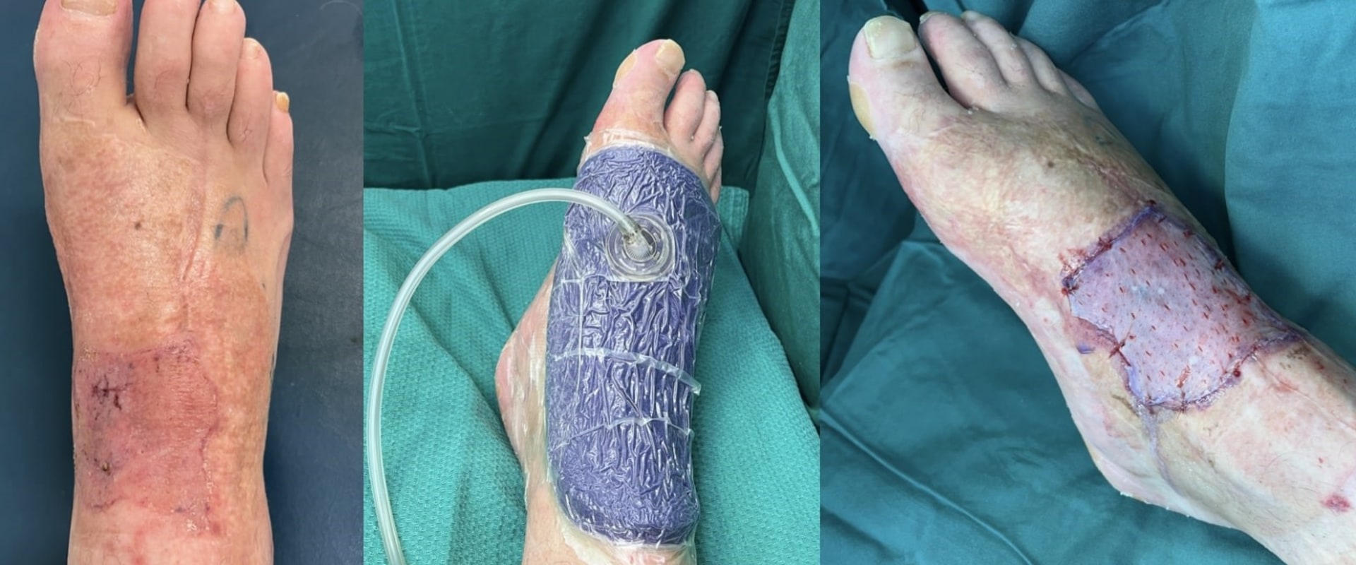 Expert Recommendations for Removing a Prevena Wound Vac