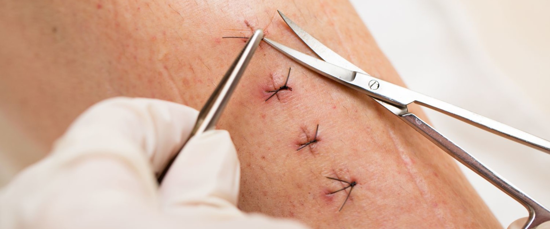 Discover How Long It Takes for Stitches to Heal After Surgery with a Recovery Timeline and Faster Healing Tips