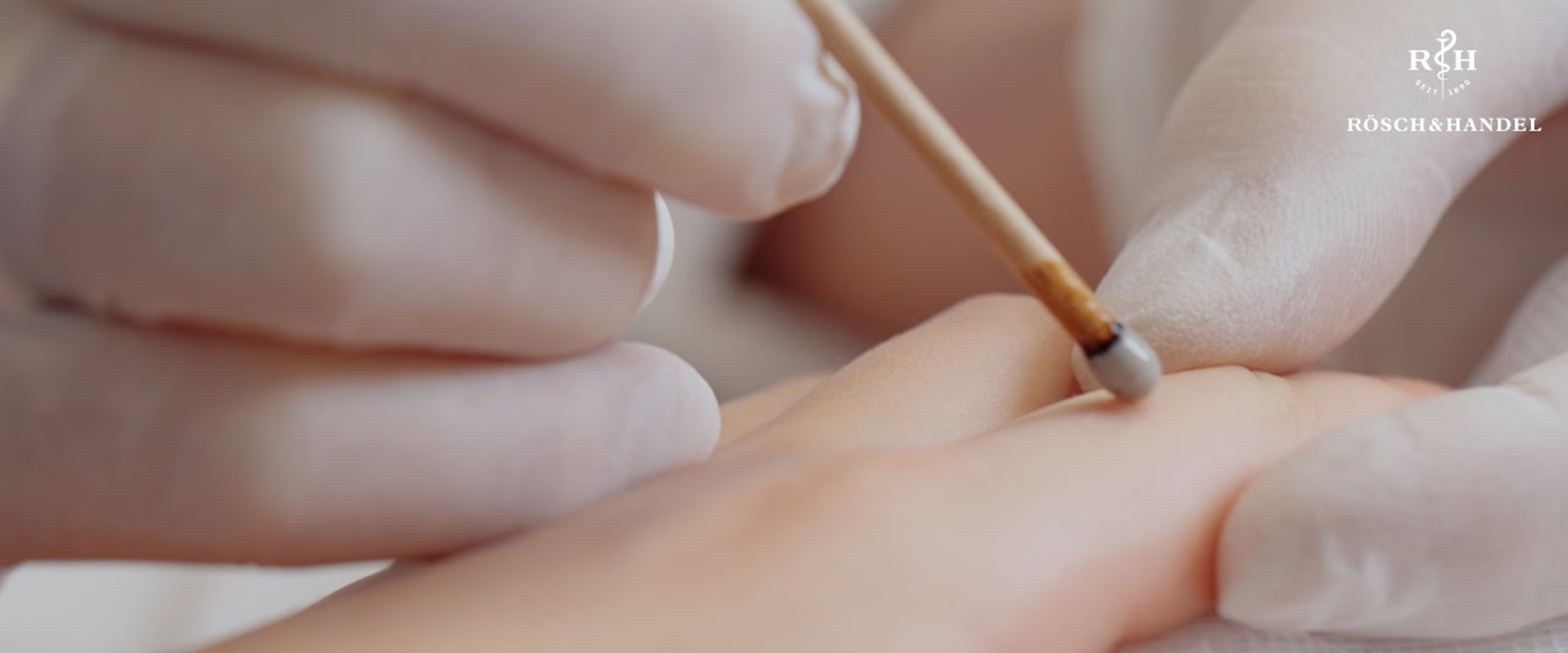 Silver Nitrate Sticks on Skin: What to Expect & How They Work