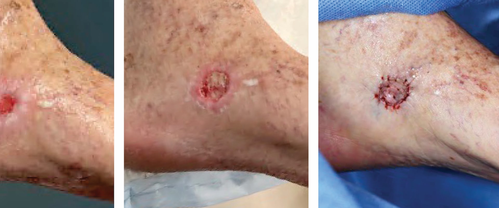 The Importance of Properly Changing Wound Vac Dressings