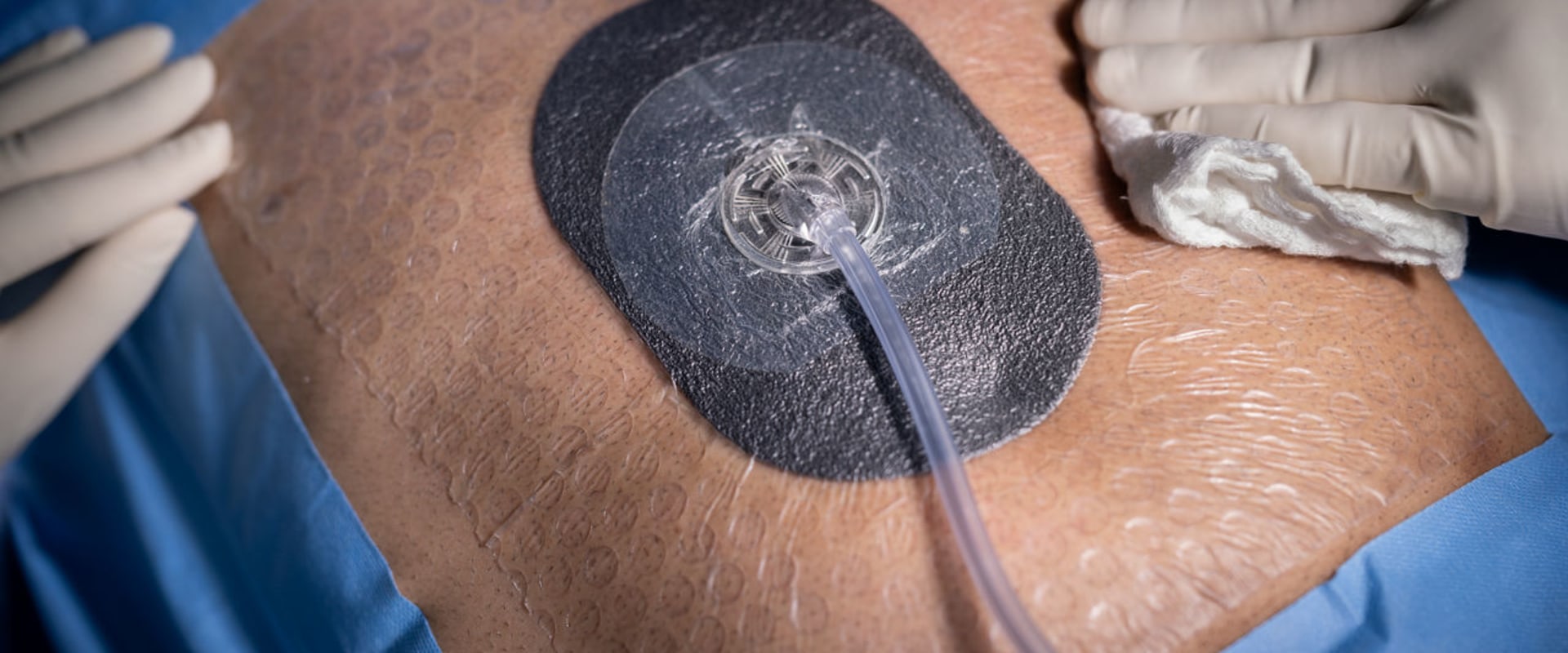 The Importance of Proper Wound Vacuum Dressing Changes: An Expert's Perspective
