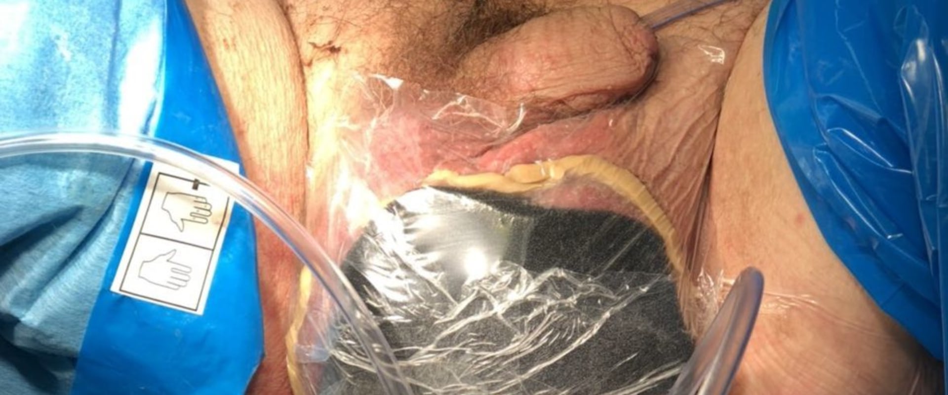 The Revolutionary Advancements of Vacuum Assisted Closure Therapy for Wound Healing
