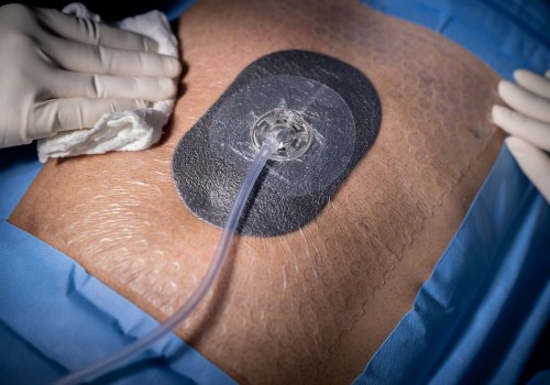 The Benefits of Wound Vacuum Therapy