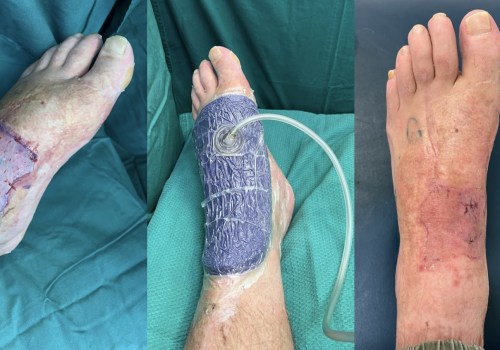 Expert Recommendations for Removing a Prevena Wound Vac