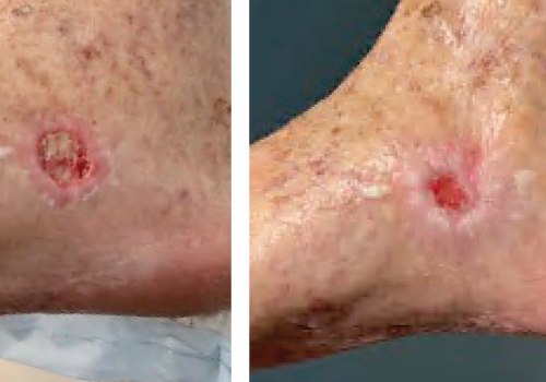 The Healing Process of Wound Aspiration Therapy: A Step-by-Step Guide