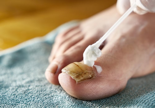 Antifungal Infection Cream Facts Dermatologists Trust Most