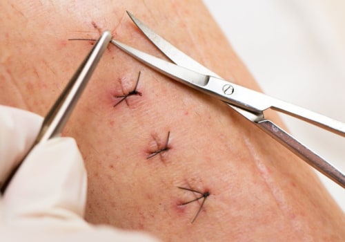 Discover How Long It Takes for Stitches to Heal After Surgery with a Recovery Timeline and Faster Healing Tips
