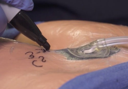 The Power of Vacuum Ventilation for Wound Healing