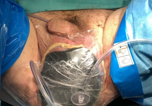 The Revolutionary Advancements of Vacuum Assisted Closure Therapy for Wound Healing